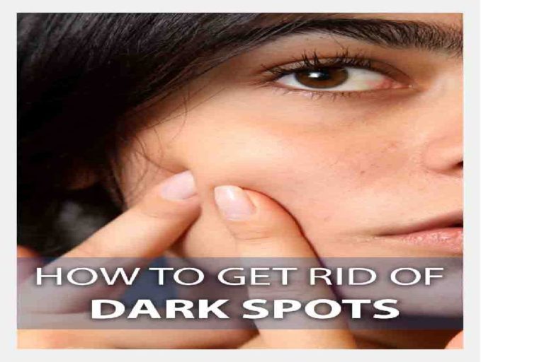 How To Get Rid Of Dark Spots? – Using a Vitamin C Cream, and More