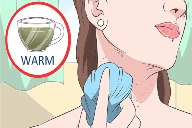 Neck Acne – Causes, Treatment, and More Neck Acne – Causes, Treatment, and More