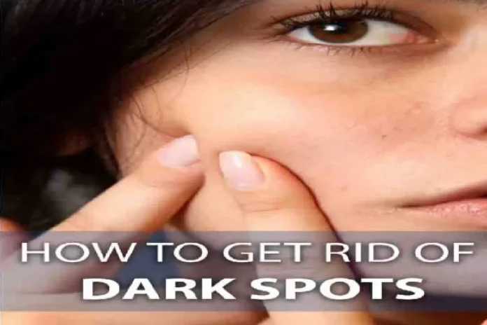 How To Get Rid Of Dark Spots